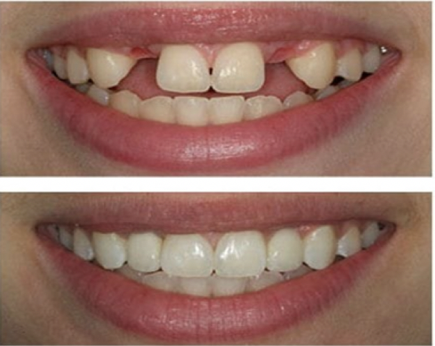 dental implant 