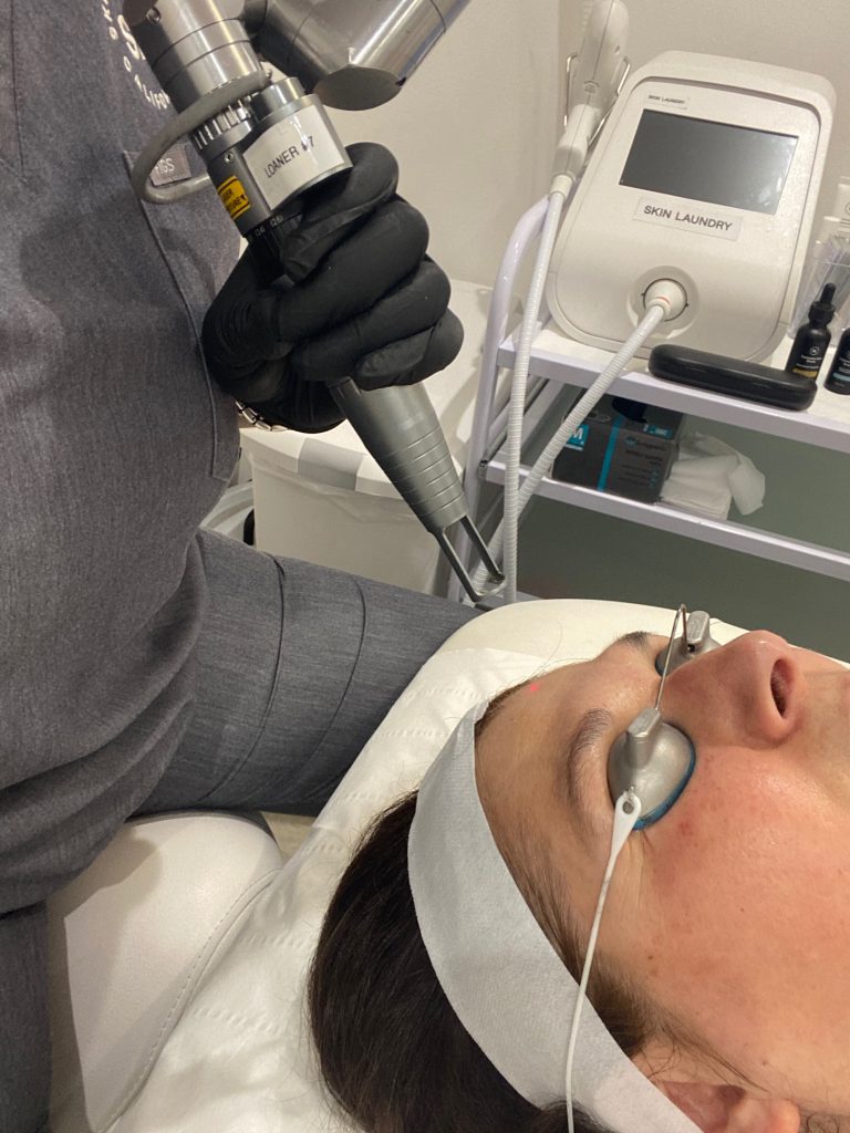 laser facial